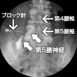 透視下左第5腰神経根造影ブロック