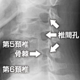 頚椎症性神経根症：左第5・第6頚椎椎間孔が狭く第6頚神経根部を圧迫