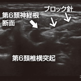 超音波ガイド下第6頚神経根ブロック