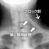 同神経根ブロックの造影所見