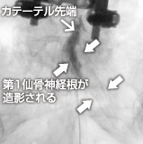 神経障害の強い右第1仙骨神経根部が、周囲のゆ着からはがれ出し造影される